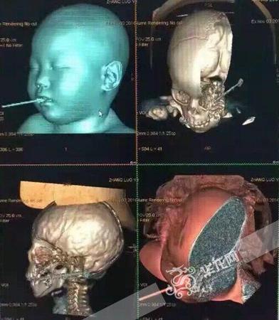 男童摔倒筷子插进嘴巴离颈动脉鞘仅2mm 手术难度大